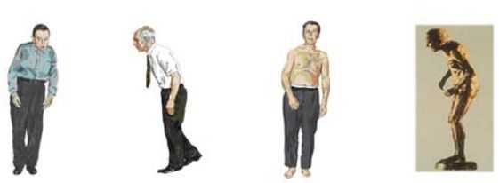 帕金森病与运动障碍专病门诊(神经内科)