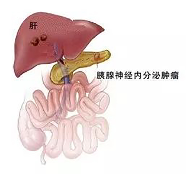 体检后差点写遗书 医生却说这个肿瘤不是癌症医疗特色 体检后差点写遗书 医生却说这个肿瘤不是癌症医疗特色
