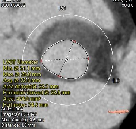 主動脈鈣化' 3D     金門美兆診所  WHO水針NGO