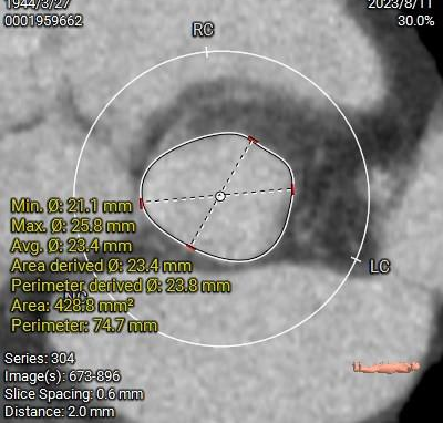 主動脈鈣化' 3D     金門美兆診所  WHO水針NGO