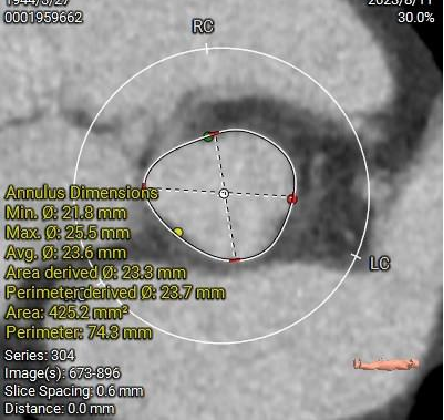 主動脈鈣化' 3D     金門美兆診所  WHO水針NGO