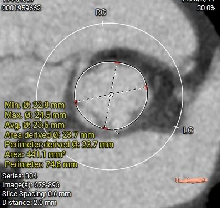 主動脈鈣化' 3D     金門美兆診所  WHO水針NGO