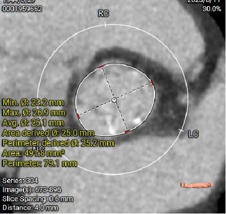 主動脈鈣化' 3D     金門美兆診所  WHO水針NGO