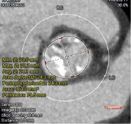 主動脈鈣化' 3D     金門美兆診所  WHO水針NGO
