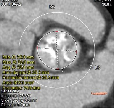 主動脈鈣化' 3D     金門美兆診所  WHO水針NGO