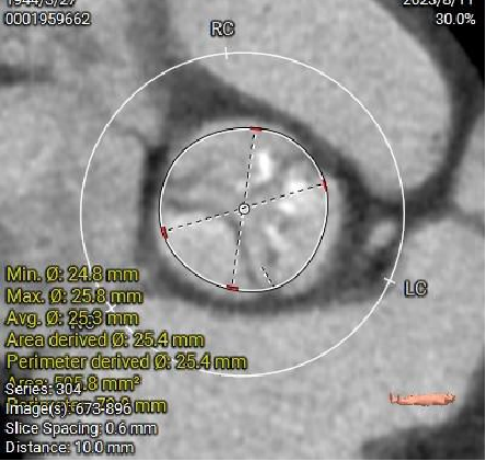 主動脈鈣化' 3D     金門美兆診所  WHO水針NGO