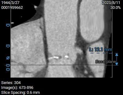 主動脈鈣化' 3D     金門美兆診所  WHO水針NGO
