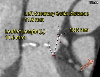 主動脈鈣化' 3D     金門美兆診所  WHO水針NGO