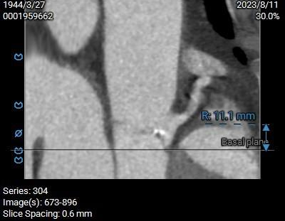 主動脈鈣化' 3D     金門美兆診所  WHO水針NGO