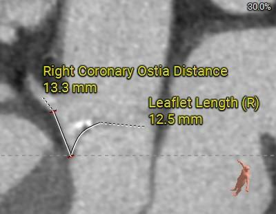 主動脈鈣化' 3D     金門美兆診所  WHO水針NGO