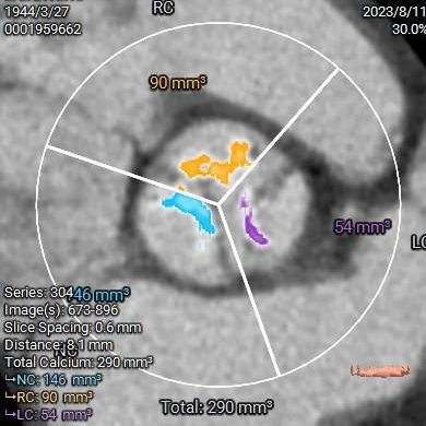 主動脈鈣化' 3D     金門美兆診所  WHO水針NGO