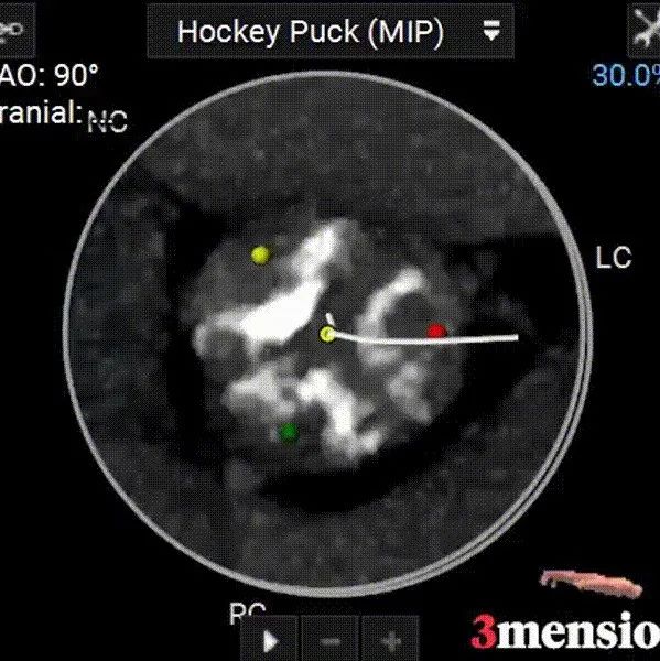 主動脈鈣化' 3D     金門美兆診所  WHO水針NGO
