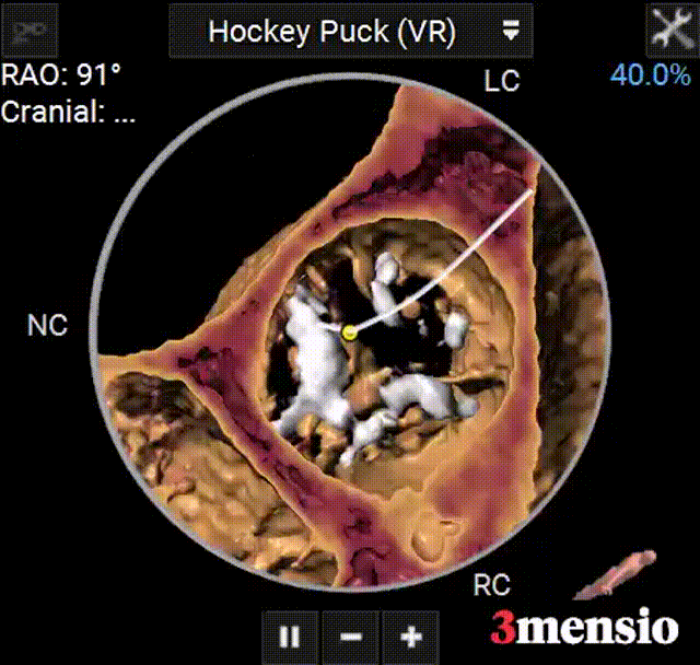 主動脈鈣化' 3D     金門美兆診所  WHO水針NGO