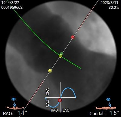 主動脈鈣化' 3D     金門美兆診所  WHO水針NGO