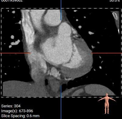 主動脈鈣化' 3D     金門美兆診所  WHO水針NGO