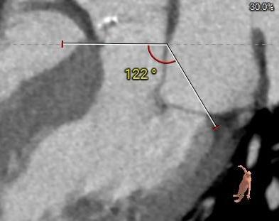 主動脈鈣化' 3D     金門美兆診所  WHO水針NGO