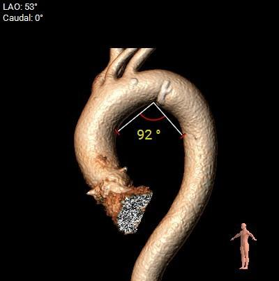 主動脈鈣化' 3D     金門美兆診所  WHO水針NGO