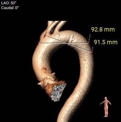 主動脈鈣化' 3D     金門美兆診所  WHO水針NGO