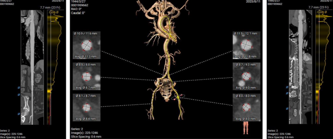 主動脈鈣化' 3D     金門美兆診所  WHO水針NGO