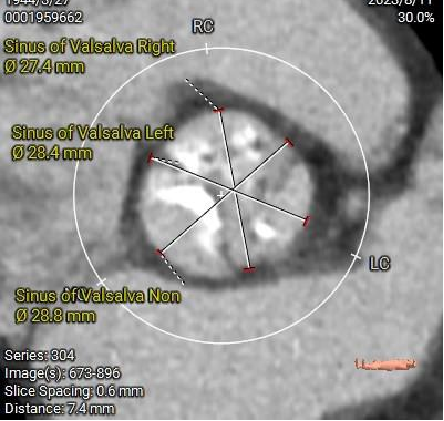 主動脈鈣化' 3D     金門美兆診所  WHO水針NGO