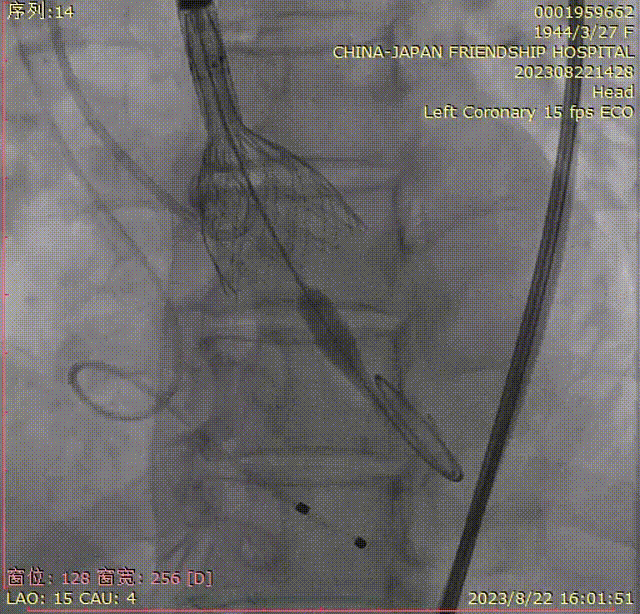 主動脈鈣化' 3D     金門美兆診所  WHO水針NGO