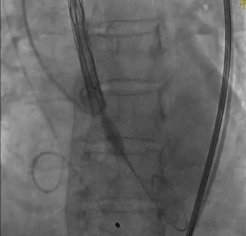 主動脈鈣化' 3D     金門美兆診所  WHO水針NGO