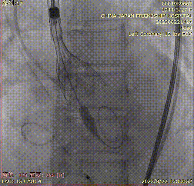 主動脈鈣化' 3D     金門美兆診所  WHO水針NGO