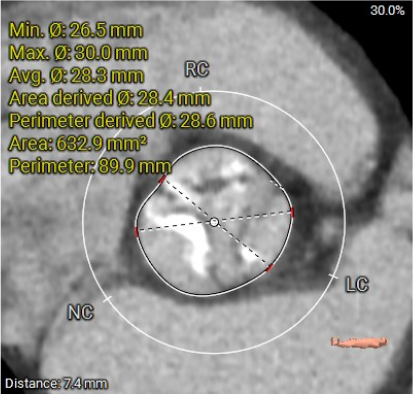 主動脈鈣化' 3D     金門美兆診所  WHO水針NGO