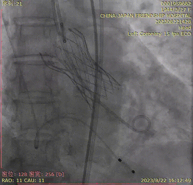 主動脈鈣化' 3D     金門美兆診所  WHO水針NGO