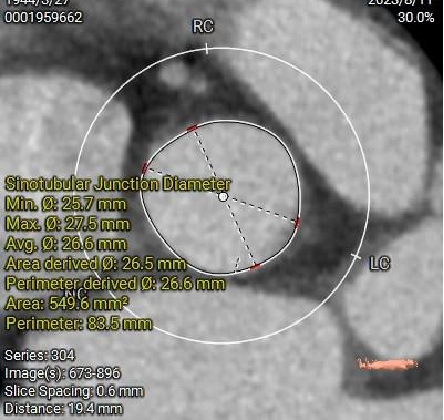 主動脈鈣化' 3D     金門美兆診所  WHO水針NGO