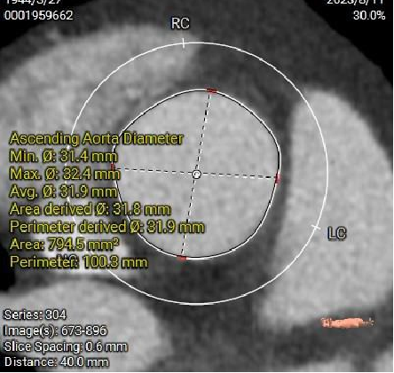 主動脈鈣化' 3D     金門美兆診所  WHO水針NGO