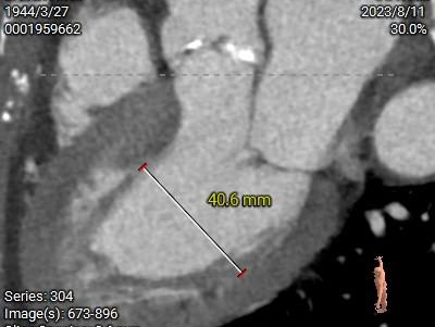 主動脈鈣化' 3D     金門美兆診所  WHO水針NGO